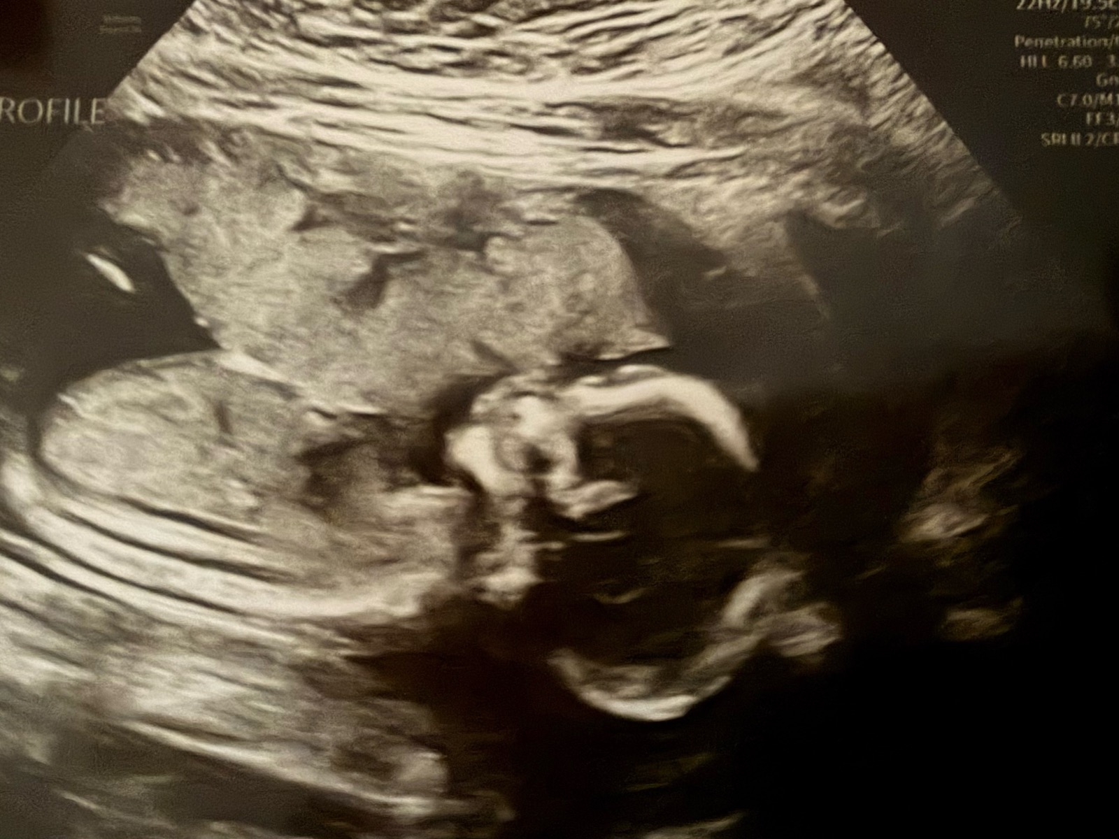 Profile ultrasound of our baby girl